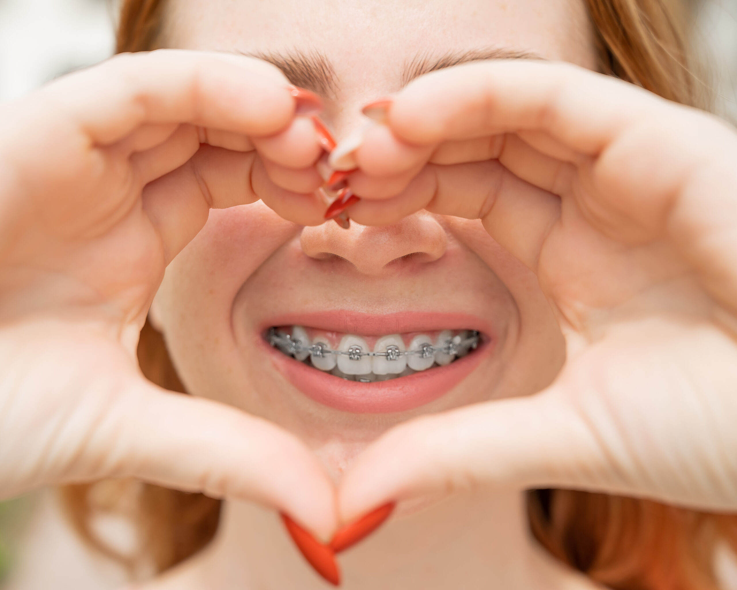 Braces with Glendale orthontics