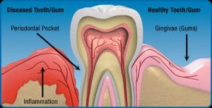 Gum Disease Peoria AZ