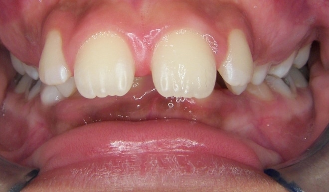 Before Orthodontic Treatment Teeters Orthodontics in Peoria, AZ