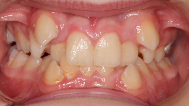 Before Orthodontic Treatment Teeters Orthodontics in Peoria, AZ