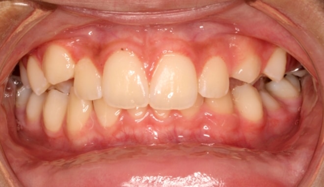 Before Orthodontic Treatment Teeters Orthodontics in Peoria, AZ