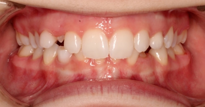 Before Orthodontic Treatment Teeters Orthodontics in Peoria, AZ