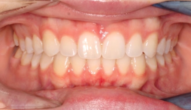 After Orthodontic Treatment Teeters Orthodontics in Peoria, AZ