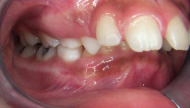 Before Orthodontic Treatment Teeters Orthodontics in Peoria, AZ