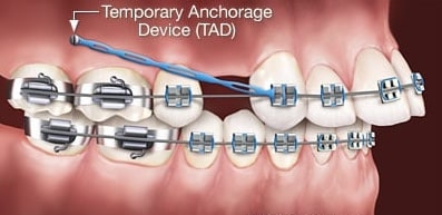 Temporary Anchorage Device TADS Teeters Orthodontics in Peoria, AZ