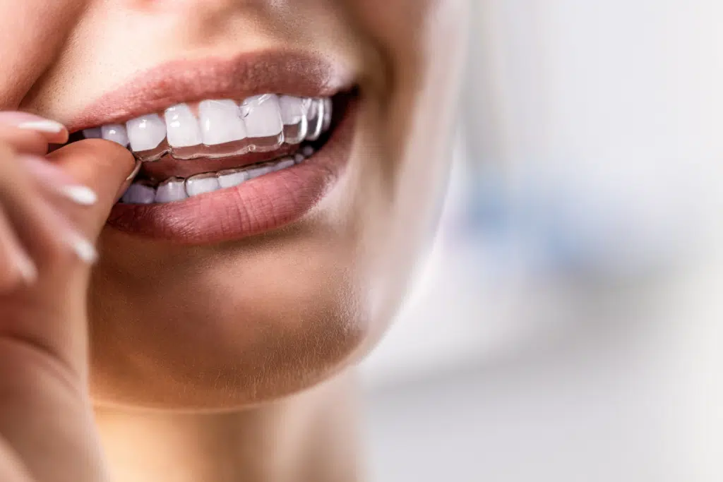 Woman removing Invisalign aligners, showcasing clear aligners and healthy smile, relevant to coffee and tea consumption guidance during treatment.